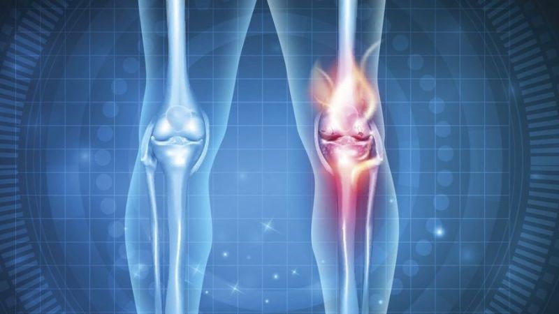 Giai đoạn 1 của thoái hóa khớp gối thường không xuất hiện triệu chứng