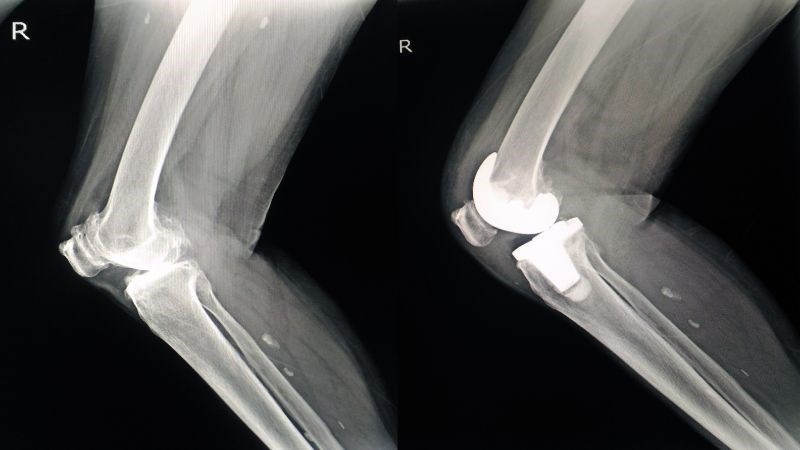X-quang là biện pháp để chẩn đoán thoái hóa khớp gối