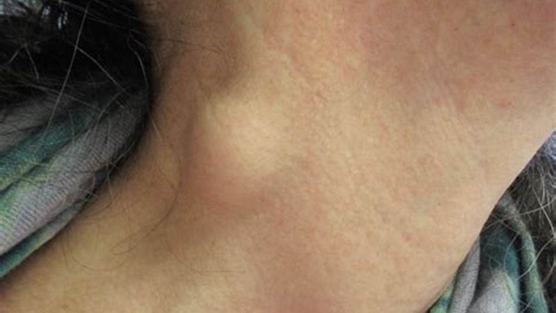 Người nhiễm HIV thường nổi hạch bạch huyết