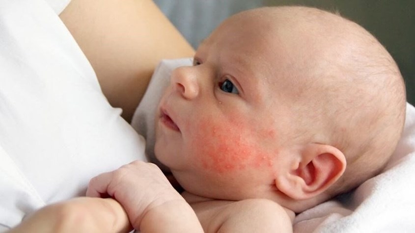 Khi trời trở lạnh bé thường bị viêm da cơ địa