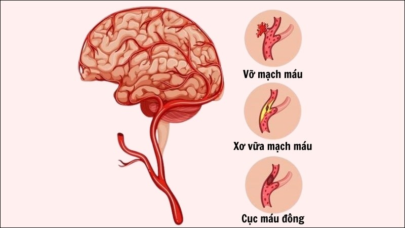 Vitamin B9 giúp giảm nguy cơ đột quỵ