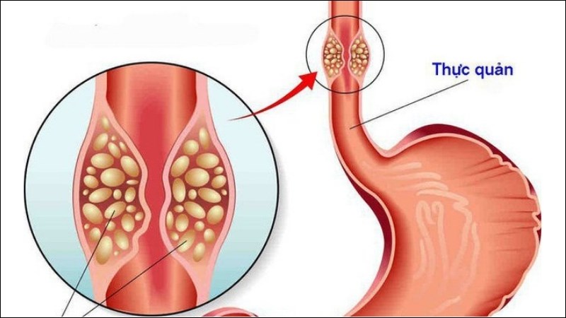 Vitamin B9 có tác dụng giảm nguy cơ mắc ung thư thực quản