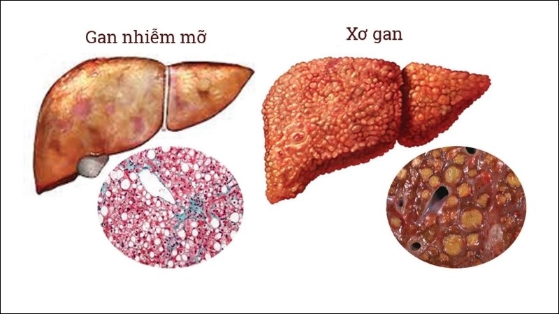 Chế độ ăn bổ sung đầy đủ Vitamin B9 giúp cải thiện tình trạng viêm và xơ hóa ở gan