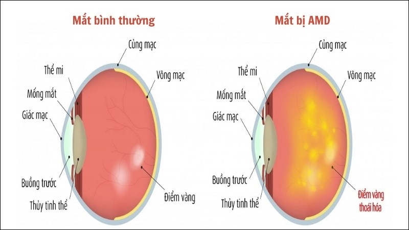 Vitamin B9 có thể làm giảm nguy cơ mắc bệnh thoái hóa điểm vàng liên quan đến tuổi tác