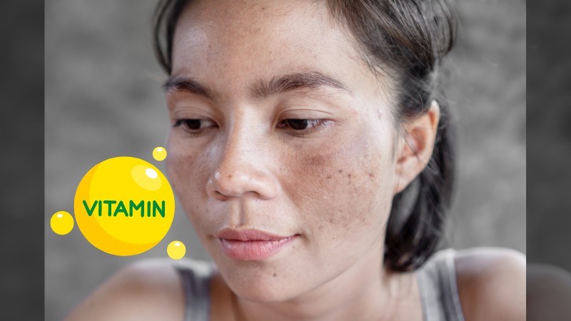 Bổ sung vitamin đầy đủ sẽ giúp đẩy nhanh tiến trình điều trị nám da