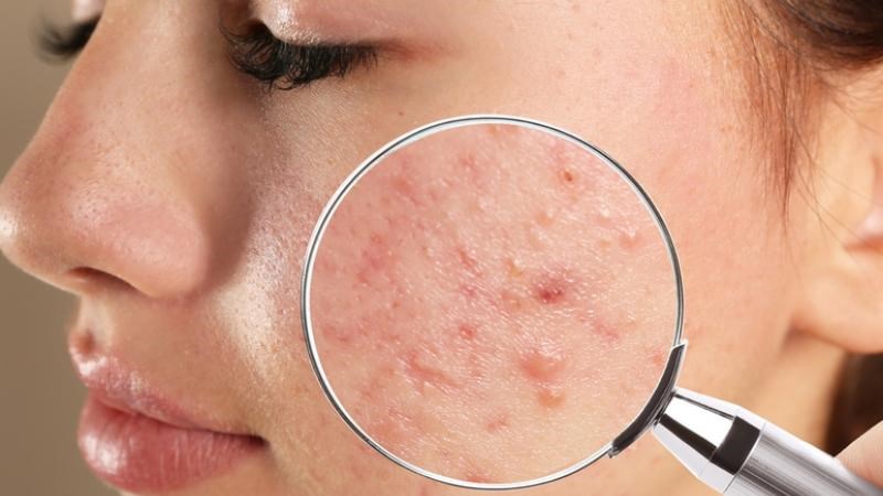 Đậu xanh có vị ngọt, tính mát giúp trị mụn trứng cá và các triệu chứng loét, nhiệt miệng