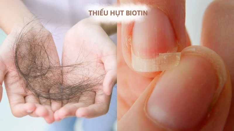 Người thiếu hụt biotin nên được bổ sung biotin đường uống