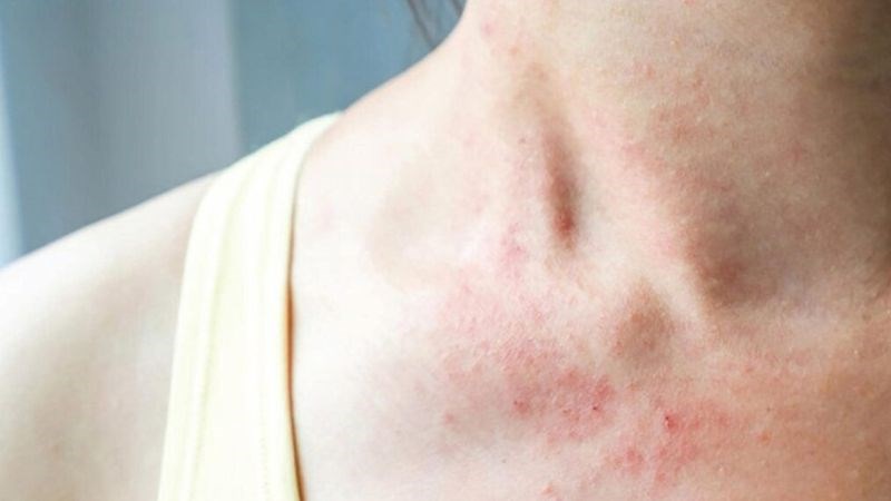 Một số trường hợp có thể gặp dị ứng sau khi ăn nấm bào ngư