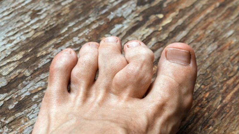 Nấm bào ngư có thể giúp hạn chế viêm khớp dạng thấp