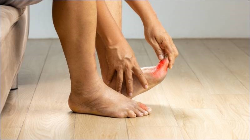 Bệnh gout là một tình trạng viêm khớp gây đau đớn và sưng các khớp