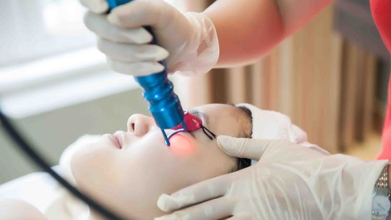 Dùng tia laser là một phương pháp hiệu quả giúp cải thiện tình trạng quầng thâm mắt