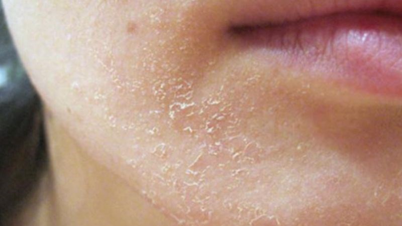 Tảo xoắn có tác dụng trong trị bệnh chàm