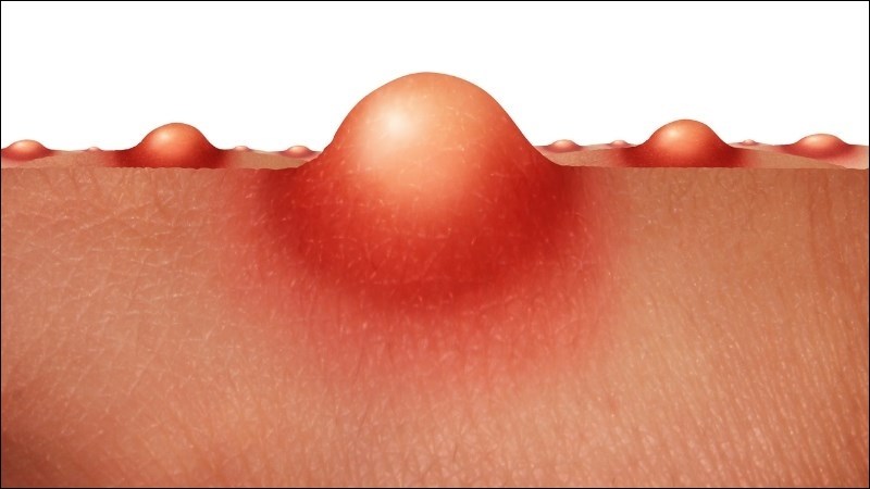 Nhàu có tính kháng khuẩn giúp ngăn ngừa mụn nhọt