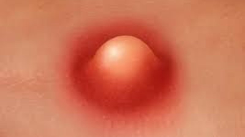 Lá nhàu tươi giã nát trị mụn nhọt Lá nhàu tươi giã nát trị mụn nhọt