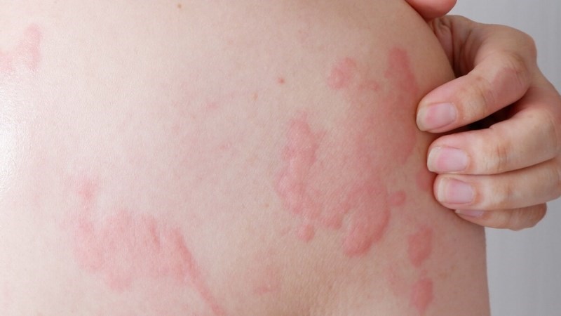 Các hợp chất trong vỏ cam có thể ngăn chặn các phản ứng dị ứng