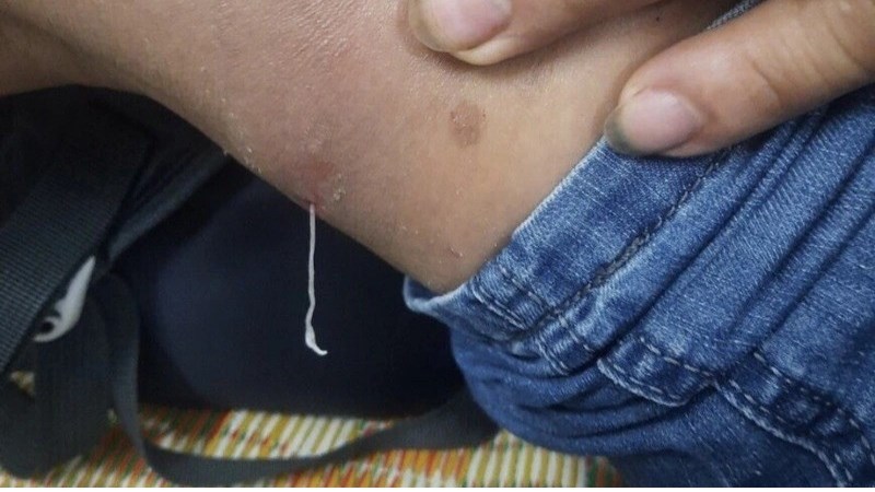 Giun rồng chui ra từ trong đùi bệnh nhân (ảnh: CDC Yên Bái)