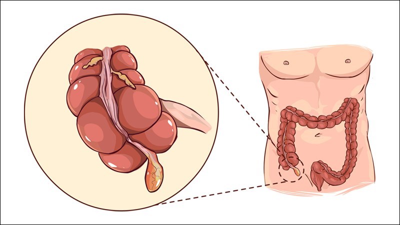 Lê là một loại trái cây có thể giúp giảm nguy cơ viêm ruột thừa