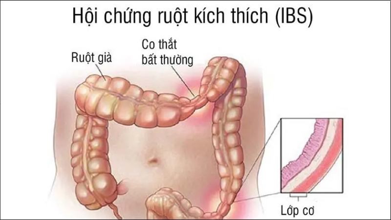 Người mắc hội chứng ruột kích thích (IBS) không nên tiêu thụ nhiều lê