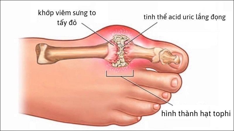 Bệnh gút (gout) là một dạng viêm khớp phổ biến gây đau và sưng khớp Bệnh gút (gout) là một dạng viêm khớp phổ biến gây đau và sưng khớp