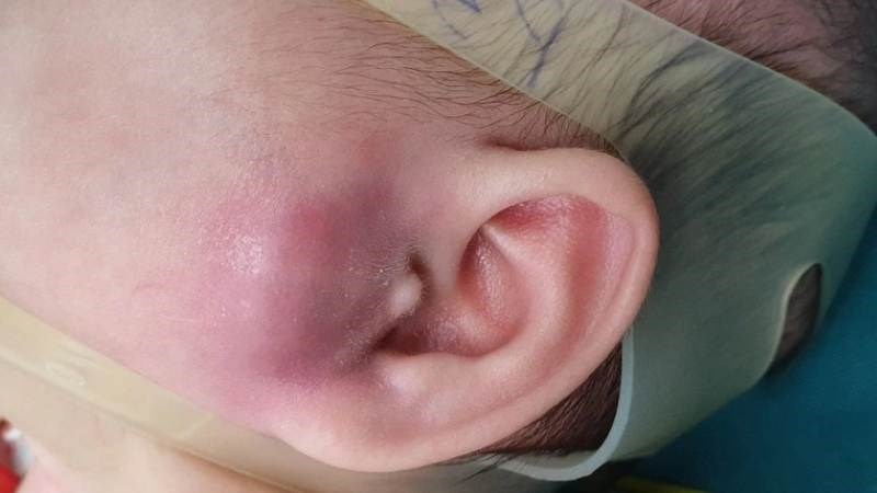 Nhọt ống tai ngoài có thể điều trị bằng hoa cúc kết hợp với các dược liệu khác