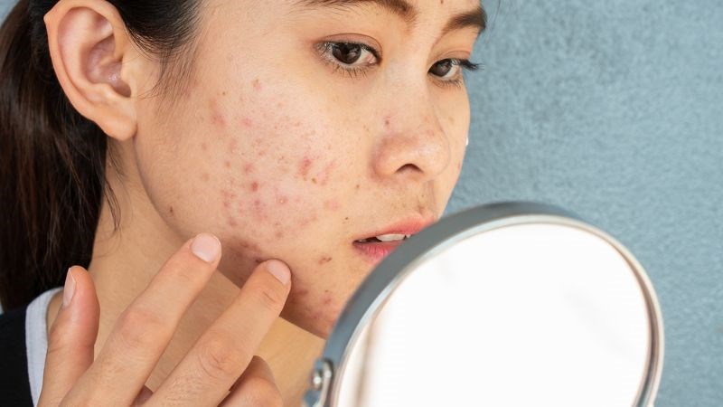 Phương pháp vi kim tảo biển hỗ trợ điều trị mụn