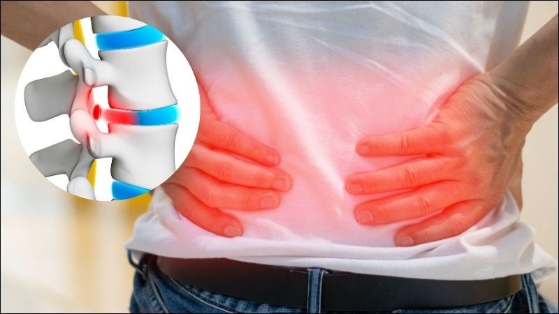 Thoát vị đĩa đệm ở thắt lưng thường gây đau thắt lưng lan xuống mông, chân