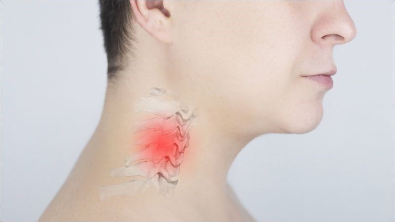 Đau sau và hai bên cổ là dấu hiệu của thoát vị đĩa đệm cổ