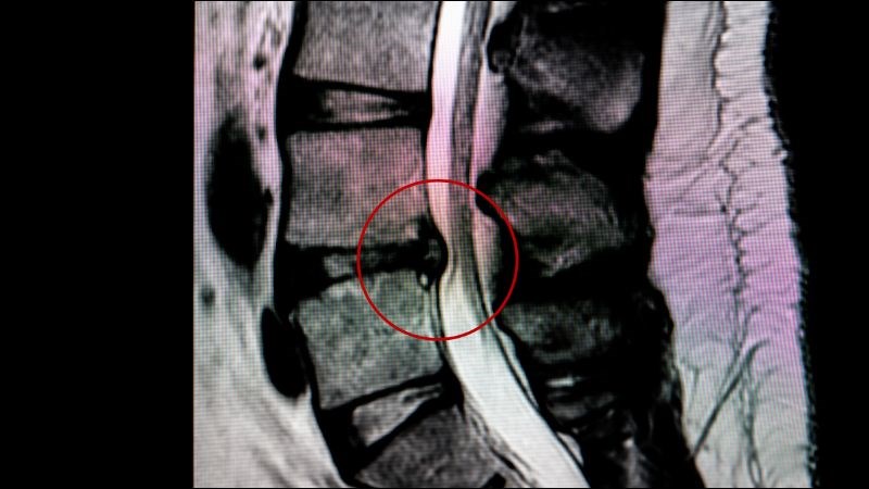 Chụp cộng hưởng từ cho hình ảnh thoát vị đĩa đệm chính xác nhất  