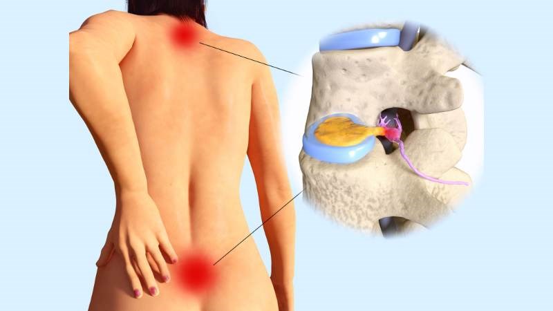 Thoát vị đĩa đệm là bệnh mạn tính do đó khó để chữa trị dứt điểm