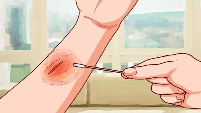 Tiểu đường giảm khả năng tuần hoàn máu làm cho vết thương lâu lành