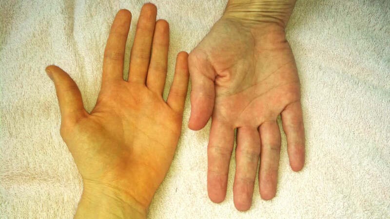 Niêm mạc da vàng là dấu hiệu cho thấy chức năng gan suy giảm