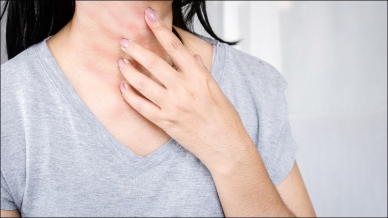 Rễ phòng phong phối hợp với bạch tật lê, ve sầu giúp chữa chứng ngoài da mãn tính 