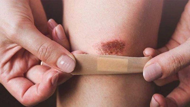 Cây vòi voi giúp chữa lành vết thương nhanh hơn