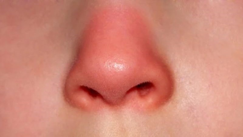 Lá cây thuốc dòi có thể dùng làm bài thuốc trị viêm mũi sưng đau