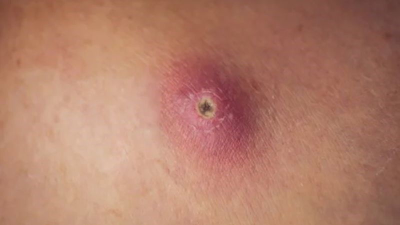 Cây thuốc dòi có thể chữa đinh nhọt, viêm da có mủ