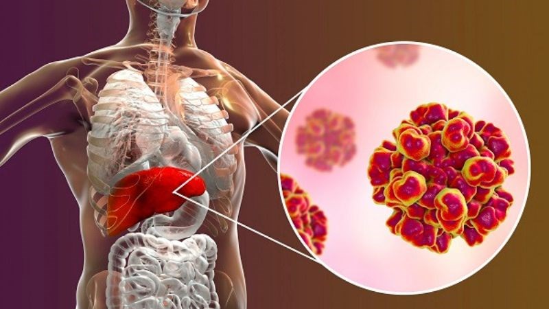 Uống quá nhiều rượu, bia có thể kích thích quá trình này gây viêm gan