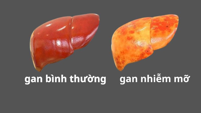 Uống rượu khiến gan bị quá tải, không thể xử lý hết mỡ dư thừa