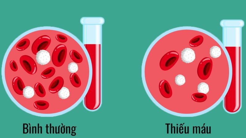 Người nhiễm ký sinh trùng giun sán có thể bị thiếu máu