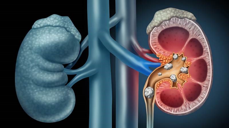 Đậu bắp có nhiều oxalat, tăng nguy cơ mắc bệnh sỏi thận