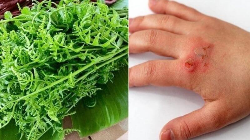 Rau dớn giúp làm dịu và hỗ trợ quá trình chữa lành vết bỏng