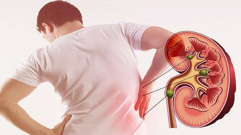 Sắc lá mơ lấy nước uống trị bí tiểu do sỏi thận