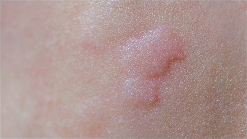 Rau ngổ giúp thuyên giảm triệu chứng của ban đỏ