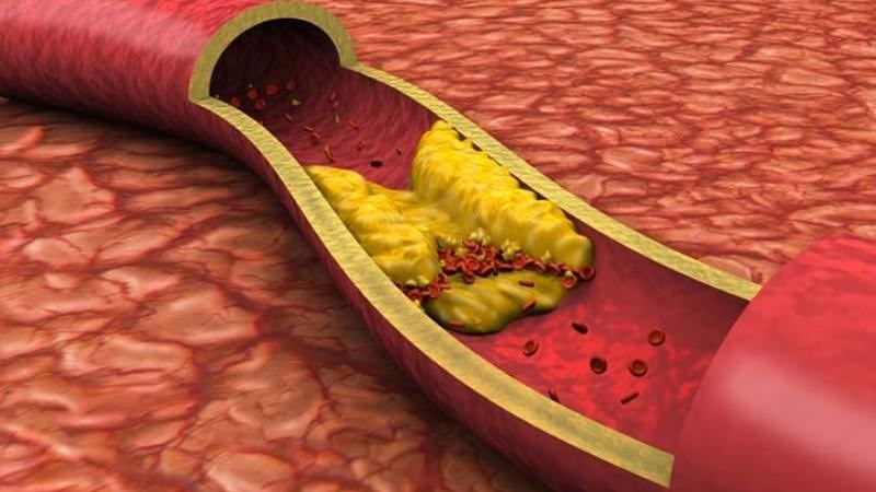 Cải kale liên kết axit mật trong hệ tiêu hóa giúp giảm nguy cơ tăng cholesterol trong máu