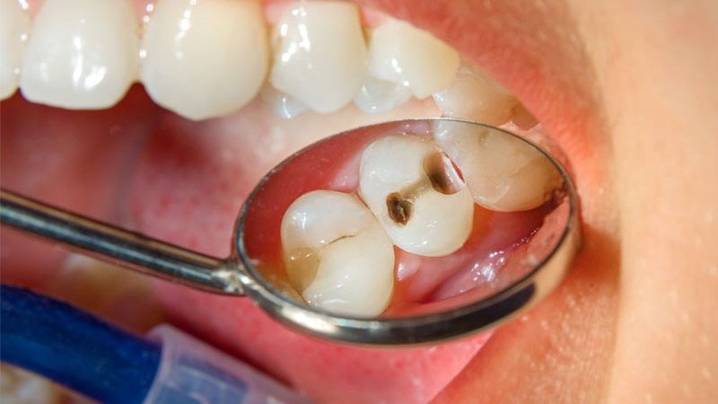 Cần gặp nha sĩ nếu tình trạng đau răng không thuyên giảm
