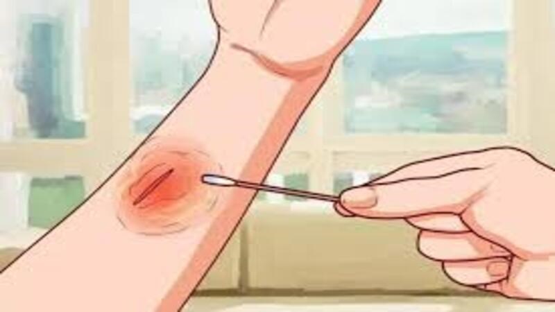  Tinh dầu hoa nhài có thể thúc đẩy quá trình lành vết thương 
