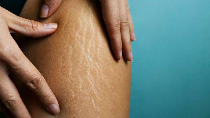 Rạn da là những vết lõm, phát triển khi da căng ra hoặc co lại nhanh chóng