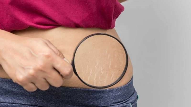 Các vết rạn có thể hình thành do cơ thể tăng trưởng nhanh chóng ở tuổi dậy thì