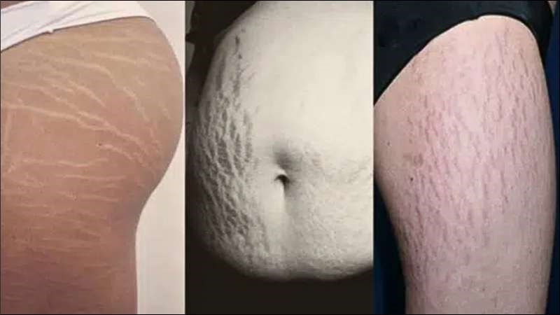 Thanh thiếu niên ở độ tuổi dậy thì có thể xuất hiện vết rạn da ở nhiều bộ phận cơ thể