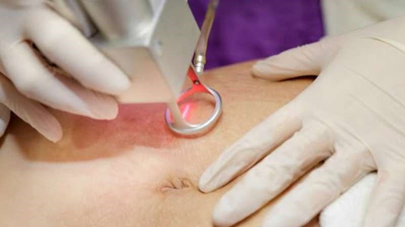 Liệu pháp laser là một thủ thuật điều trị rạn da