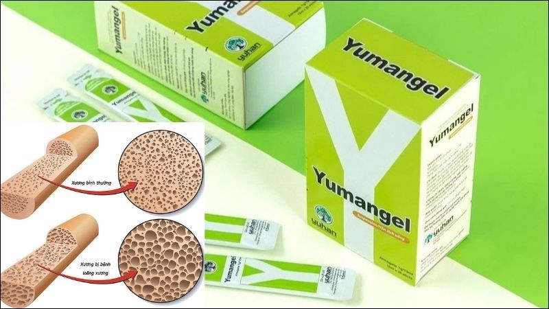 Sử dụng thuốc dạ dày chữ y ở liều cao có thể gây loãng xương